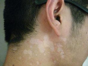 白癜风患者怎样提高自身免疫力
