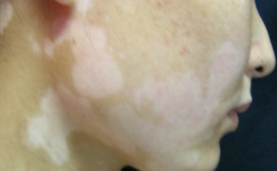 白癜风危害图片