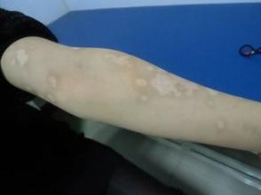 双臂出现白癜风该怎么治疗